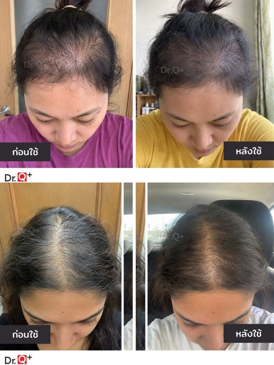 Dr.Q Hair Serum ภาพก่อนและหลัง 3 เดือน