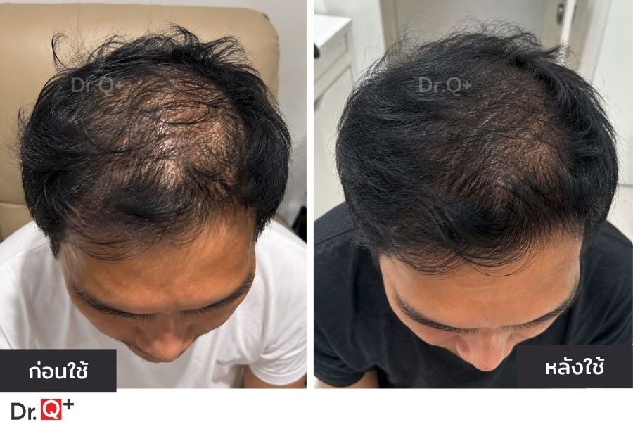วิธีดูแลหนังศีรษะด้วย Dr.Q Hair Serum