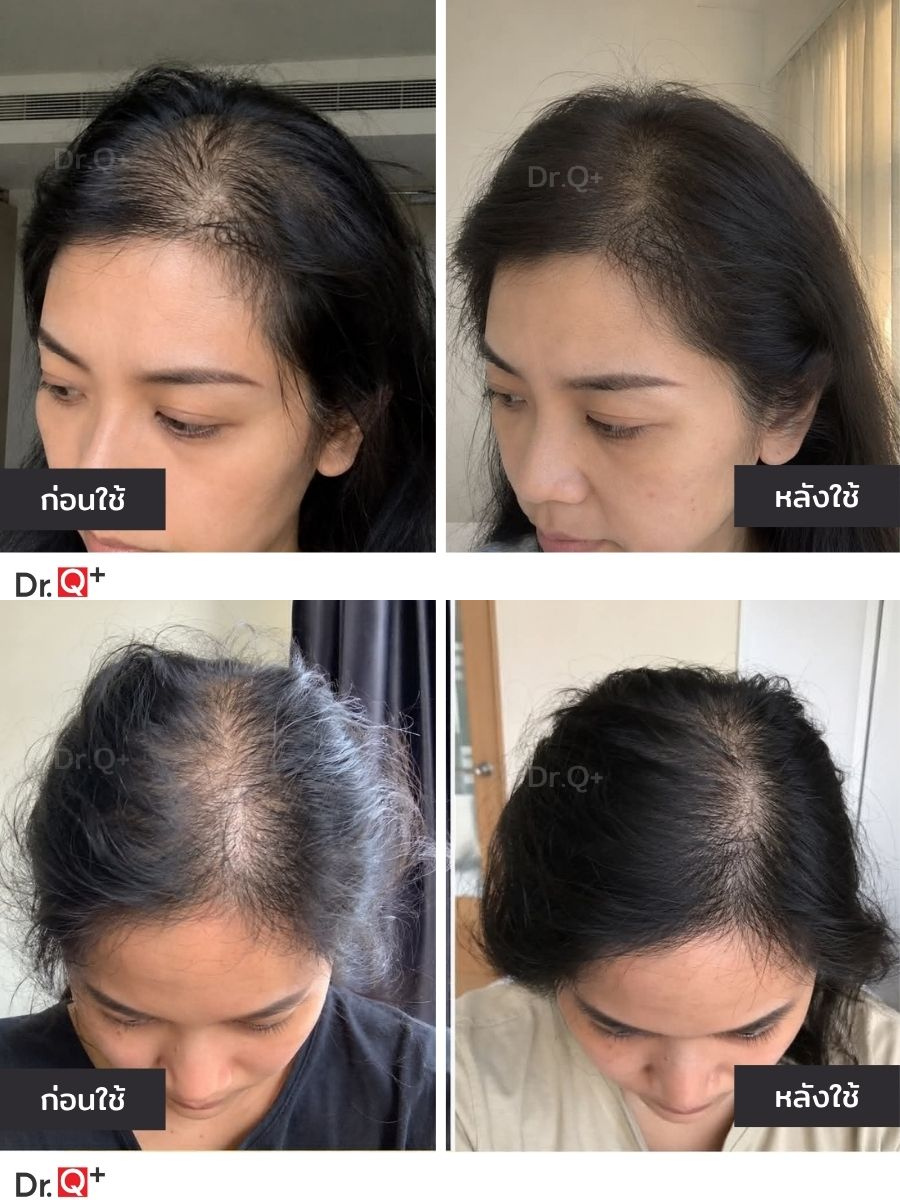 Dr.Q Advanced Hair Serum และสารสกัดสำคัญ