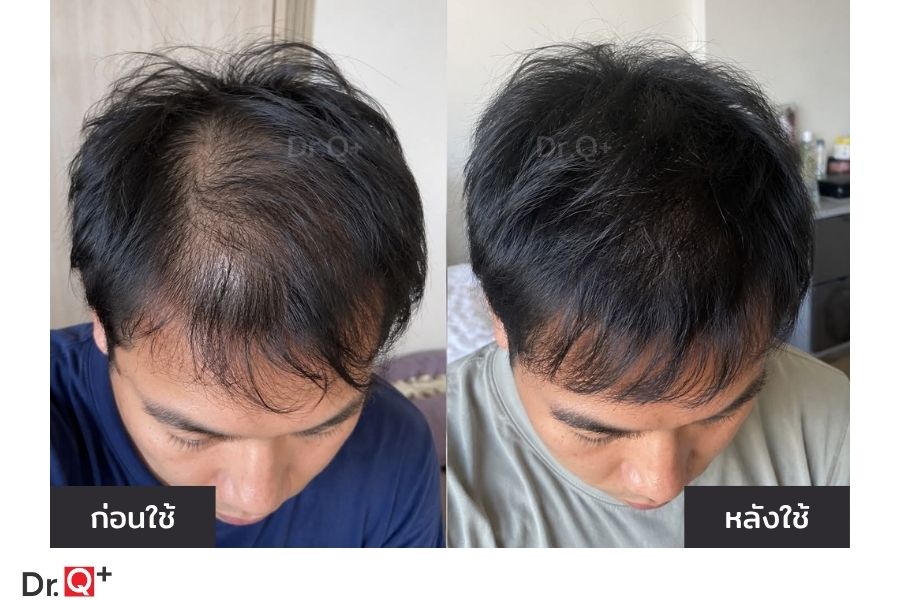 ข้อมูล Baicapil สำหรับการดูแลเส้นผม