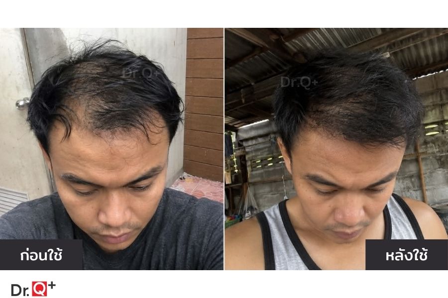 โปรโมชั่น Dr.Q ANNU-Plus 590 990 และ 1390 บาท