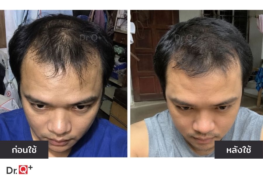 ข้อมูล Procapil สำหรับการดูแลรากผม